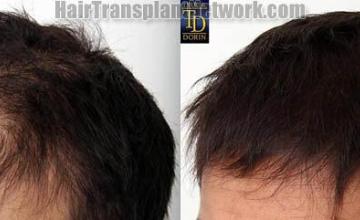 Hair transplantation surgery before and after images