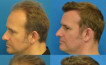 Hair transplantation surgery before and after pictures