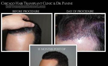 Hair transplantation surgery before and after images