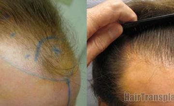 Hair restoration procedure results