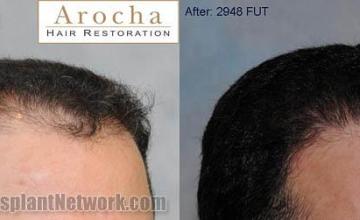 Before and after hair transplant procedure images