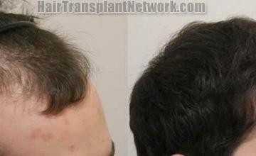 Before and after hair transplant procedure images