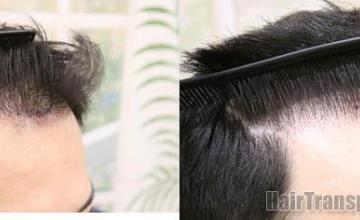 Hair transplantation surgery before and after photos