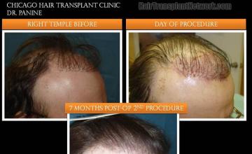 Hair restoration procedure before and after results