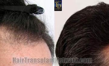 Hair transplantation surgery before and after images