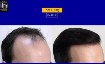 Hair transplantation surgery before and after images