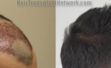 Hair transplantation surgery before and after photos