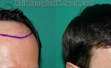 Hair transplantation surgery before and after photos