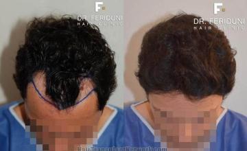 Top view - Before and after surgical hair replacement