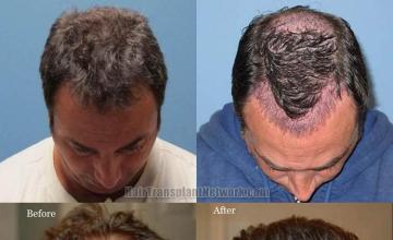 Hair transplantation surgery before and after photos