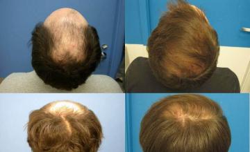 Hair transplantation procedure photo results