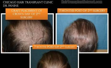 Before and after surgical hair restoration images