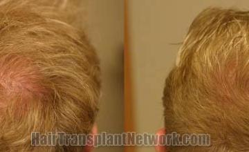 Hair restoration procedure before and after pictures