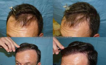 Hair restoration procedure result photos before and after