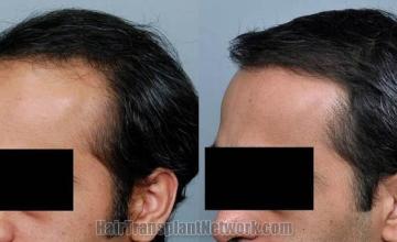 Hair transplantation surgery before and after images