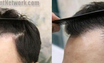 Hair transplantation surgery before and after images