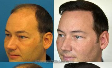 Hair transplantation surgery before and after pictures