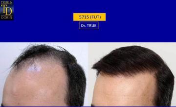 Hair transplantation surgery before and after pictures
