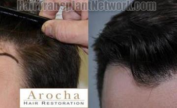 Hair transplantation surgery before and after images