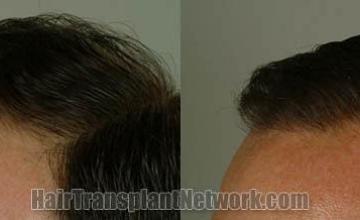 Hair transplantation surgery before and after photos