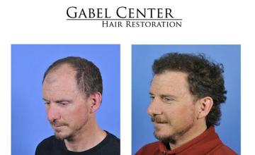 Left oblique view before and after hair transplant