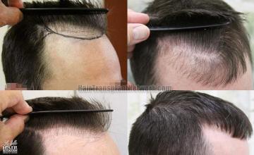 Hair restoration procedure before and after results