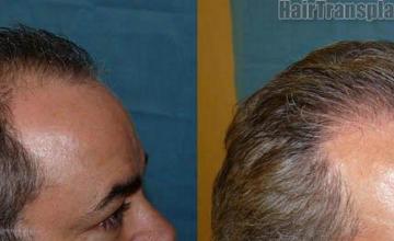 Hair replacement surgery procedure pictures - Right view