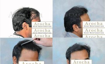 Right side hair restoration before and after results