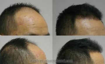 Hair restoration procedure before and after results