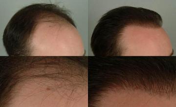 Hair transplantation surgery before and after images