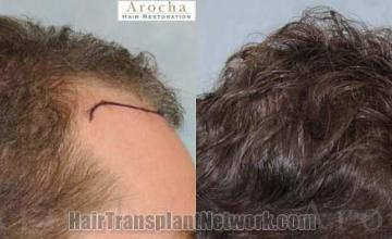 Hair restoration procedure before and after pictures