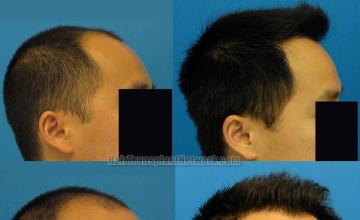 Hair transplantation surgery before and after images