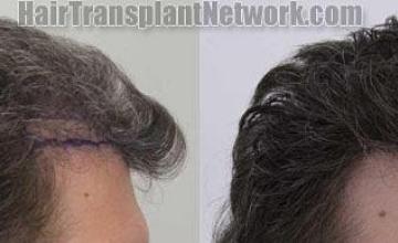 Hair transplantation surgery before and after images