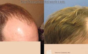 Hair transplantation surgery before and after photos