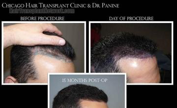 Hair transplantation surgery before and after photos