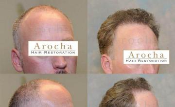 Right view - before and after hair transplant