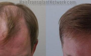 Top view before and after hair restoration procedure