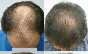 Top view before and after hair restoration photos