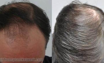 Before and after hair transplant procedure images