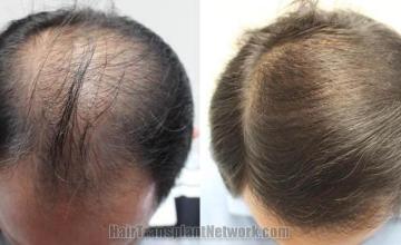 Top view before and after hair restoration results