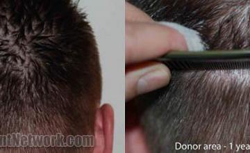 Back view before and after hair transplantation results