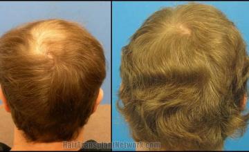 Hair restoration procedure before and after pictures