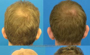 Hair restoration procedure before and after pictures