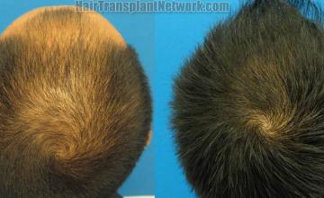 Hair restoration procedure before and after pictures