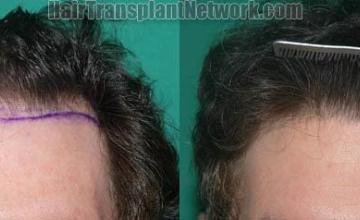 Hair restoration procedure before and after results