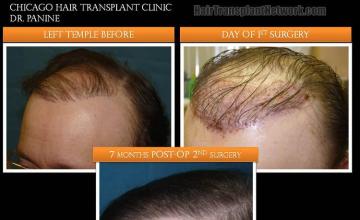 Hair transplantation surgery before and after photos