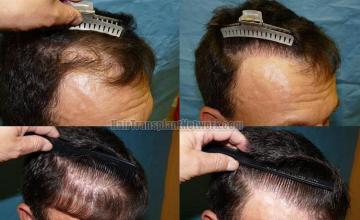 Right view before and after hair restoration images