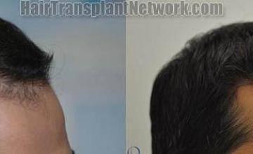 Hair restoration procedure before and after results