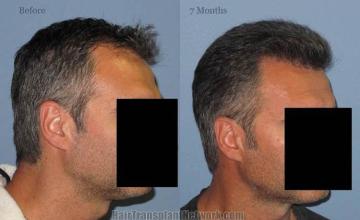 Hair transplantation surgery before and after images