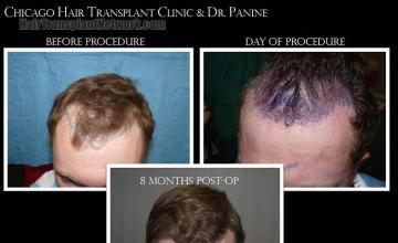 Hair restoration procedure before and after pictures